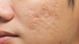 Acne scars