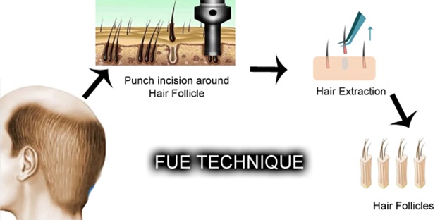 Surgical Hair Transplant