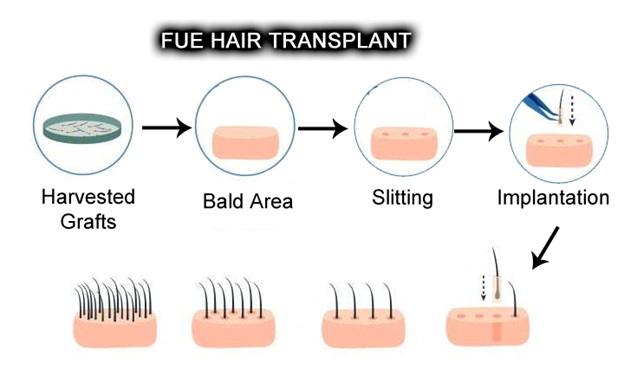 Surgical Hair Transplant