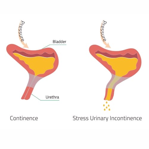 Stress Urinary Incontinence