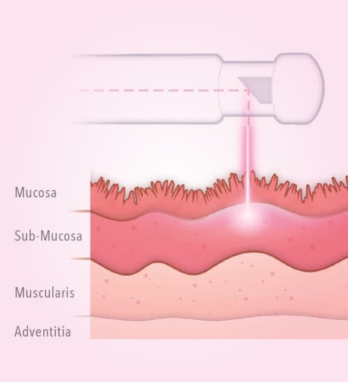 Stress Urinary Incontinence