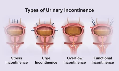 Stress Urinary Incontinence